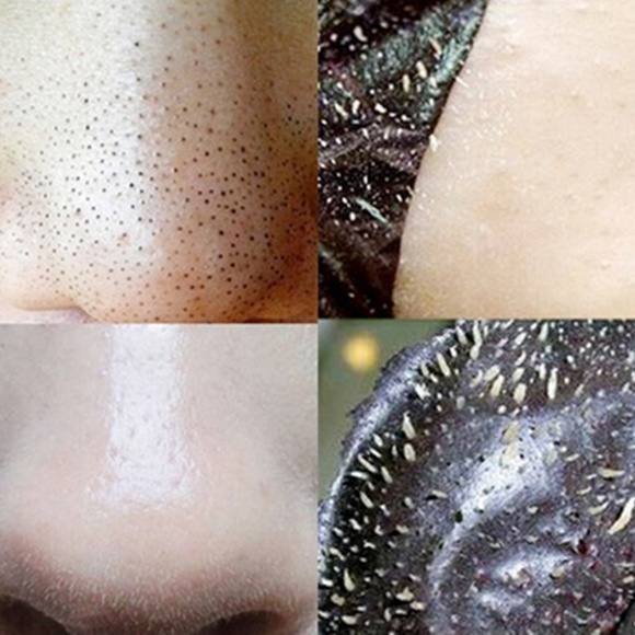Blackhead Remover Deep Cleaning Purifying Peel Acn - Picture 5 of 5